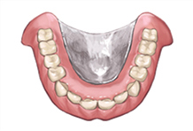 金属床義歯