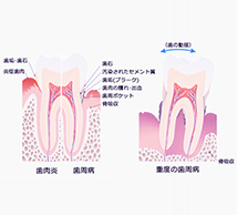 歯周病とは